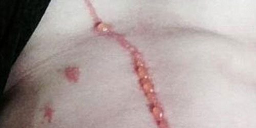 แมงมุมฝังตัวใต้ผิวหนังหนุ่มออสซี่