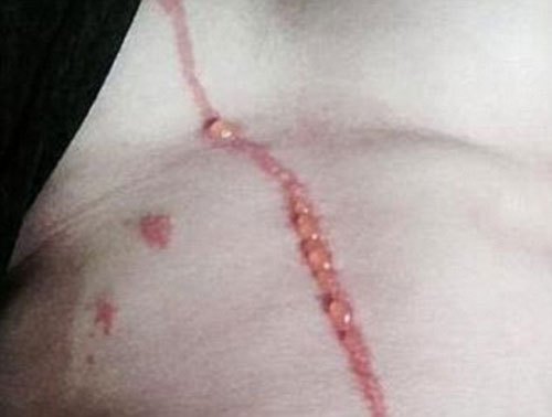 แมงมุมฝังตัวใต้ผิวหนังหนุ่มออสซี่